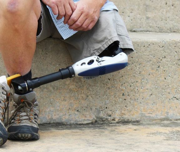 amputee ampuytated leg foot diabetes diabetic