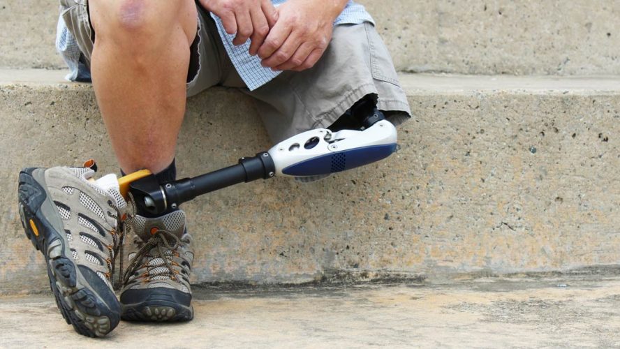 amputee ampuytated leg foot diabetes diabetic