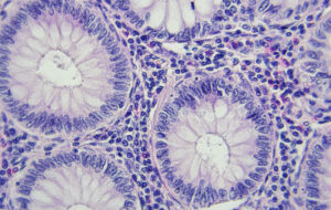 Colon cancer microscopic photography, magnification x400