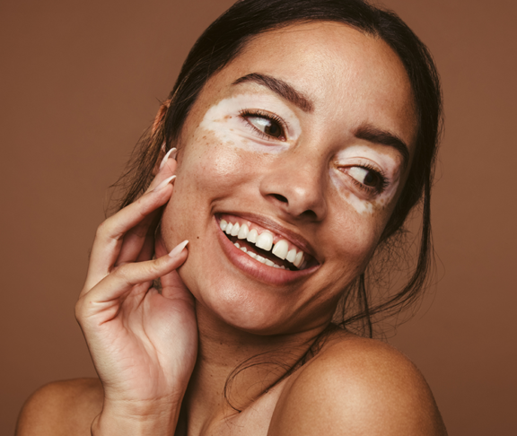 Woman with skin pigmentation