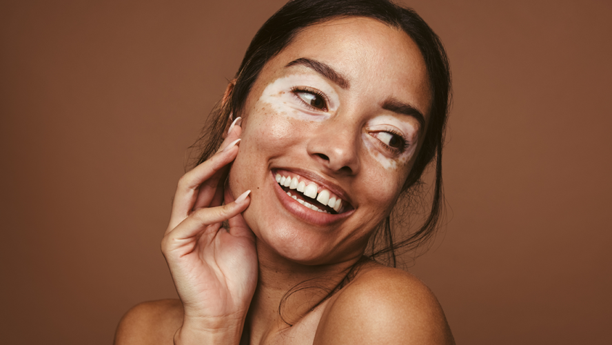 Woman with skin pigmentation